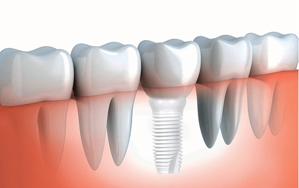 dental implants Herndon VA