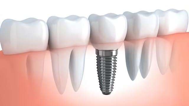 dental surgery Herndon VA, tooth implant Herndon VA