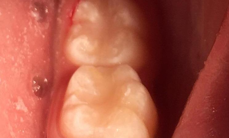 Dental-Fillings-After-Image