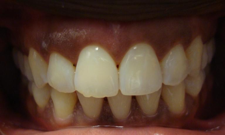 Invisalign-treatment-After-Image