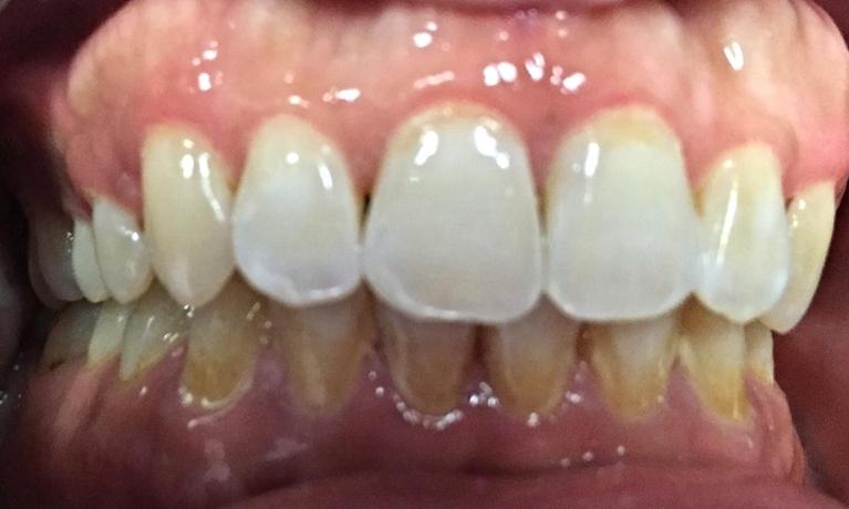 Herndon-Dentist-Cleaning-Before-Image