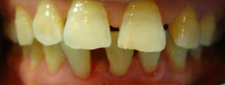 Invisalign-Treatment-Before-Image