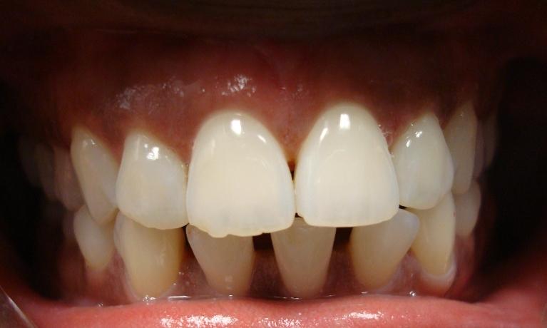 Invisalign-treatment-Before-Image